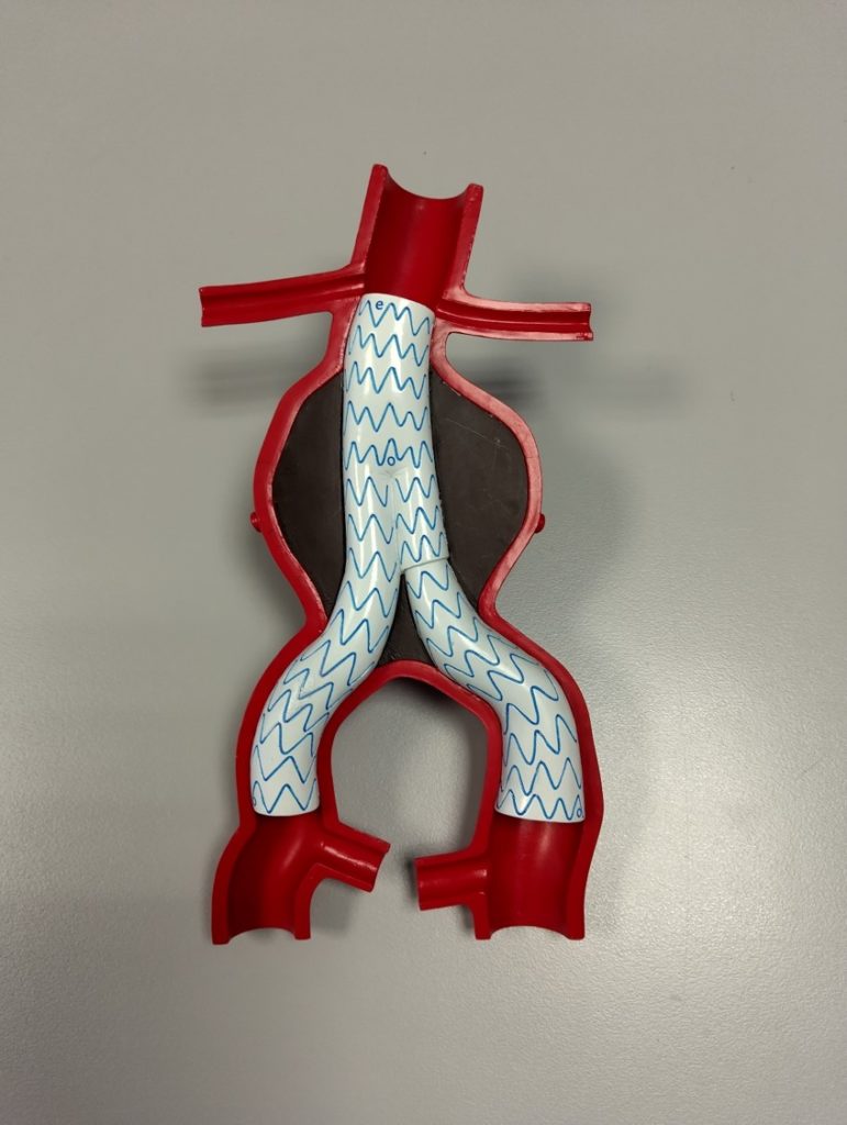 Aorte (en rouge) déformée par l’anévrysme (zone noire),  ce dernier est traité par une endoprothèse (en blanc) positionnée à l’intérieur des vaisseaux pour rétablir son calibre